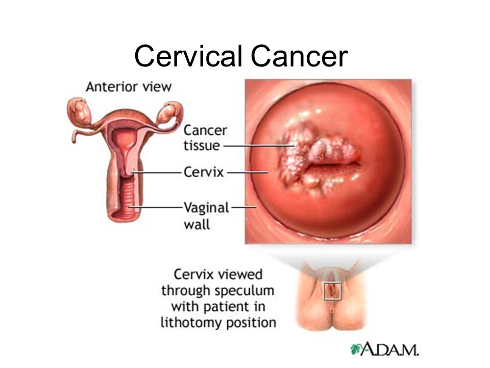 Penetrate cer cervix