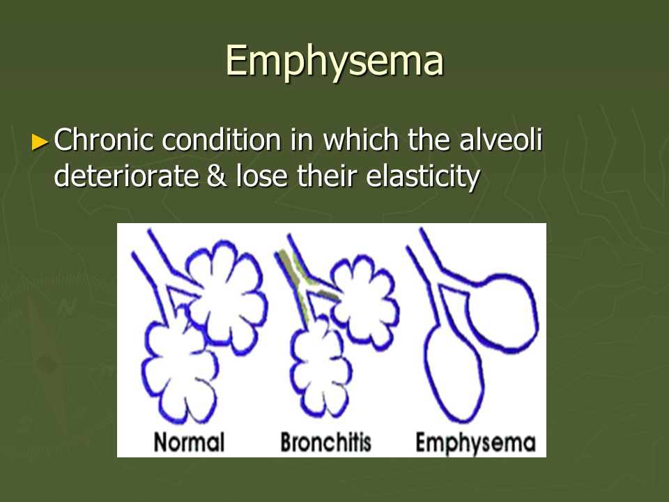 Emphysema Chronic condition in which the alveoli deteriorate & lose their elasticity