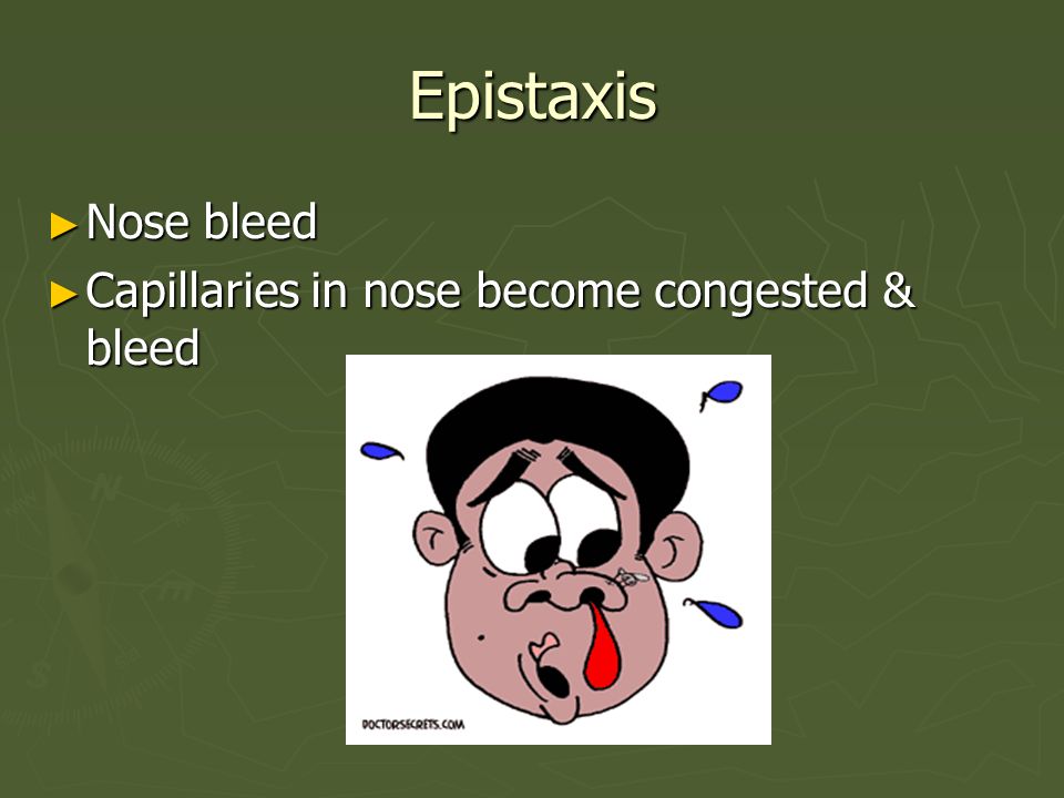 Epistaxis Nose bleed Capillaries in nose become congested & bleed