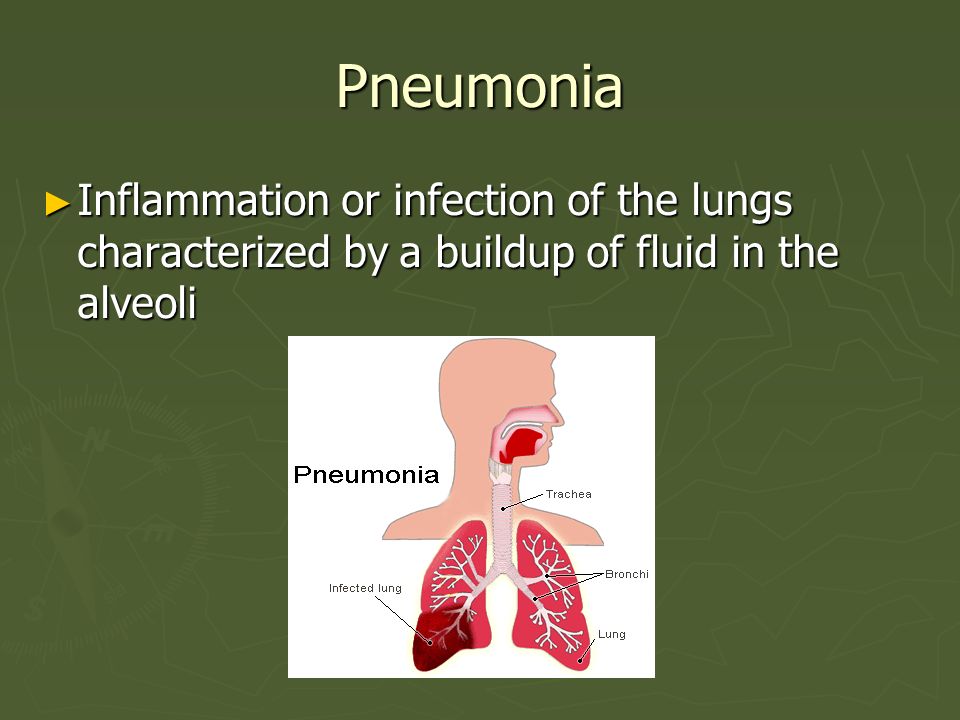 Pneumonia Inflammation or infection of the lungs characterized by a buildup of fluid in the alveoli.