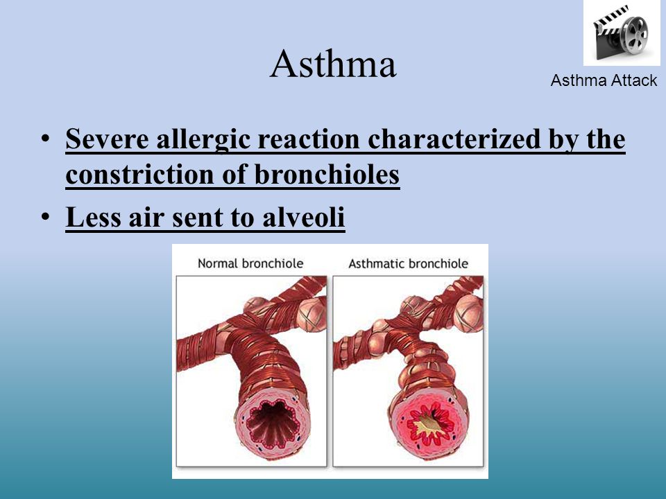 Asthma Asthma Attack. Severe allergic reaction characterized by the constriction of bronchioles.