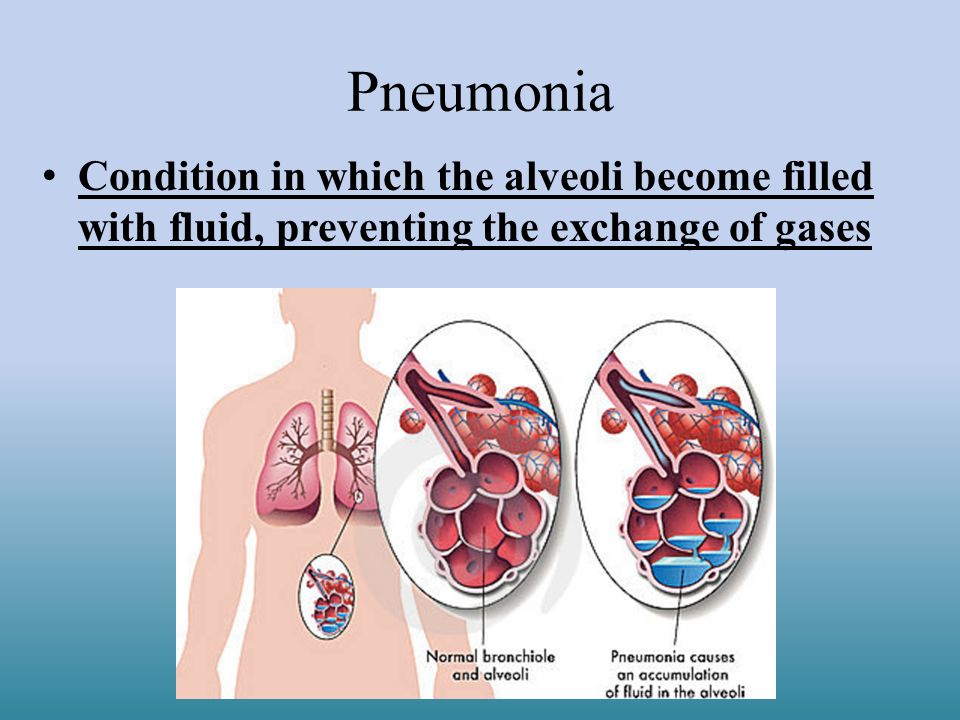 Pneumonia Condition in which the alveoli become filled with fluid, preventing the exchange of gases