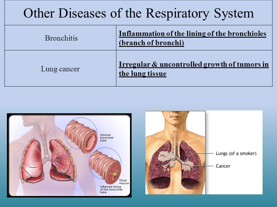 Other Diseases of the Respiratory System