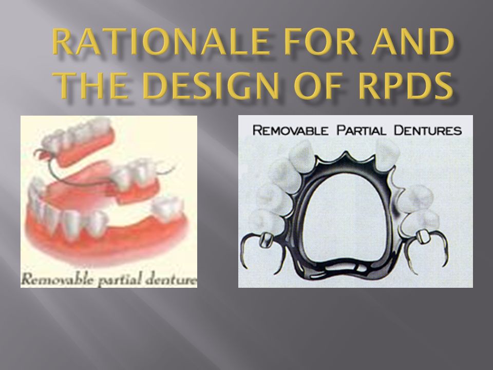 rationale for and the design of rpds ppt video online download removable partial denture design