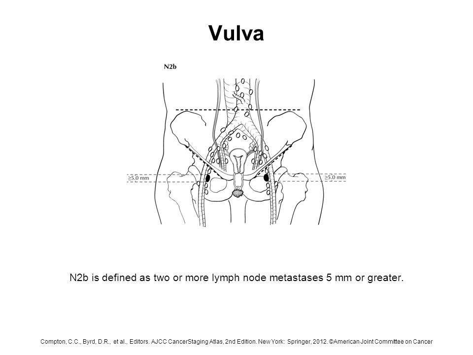 N2b is defined as two or more lymph node metastases 5 mm or greater.