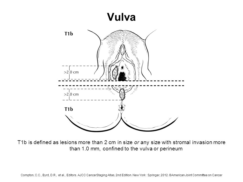 Vulva T1b is defined as lesions more than 2 cm in size or any size with stromal invasion more than 1.0 mm, confined to the vulva or perineum.