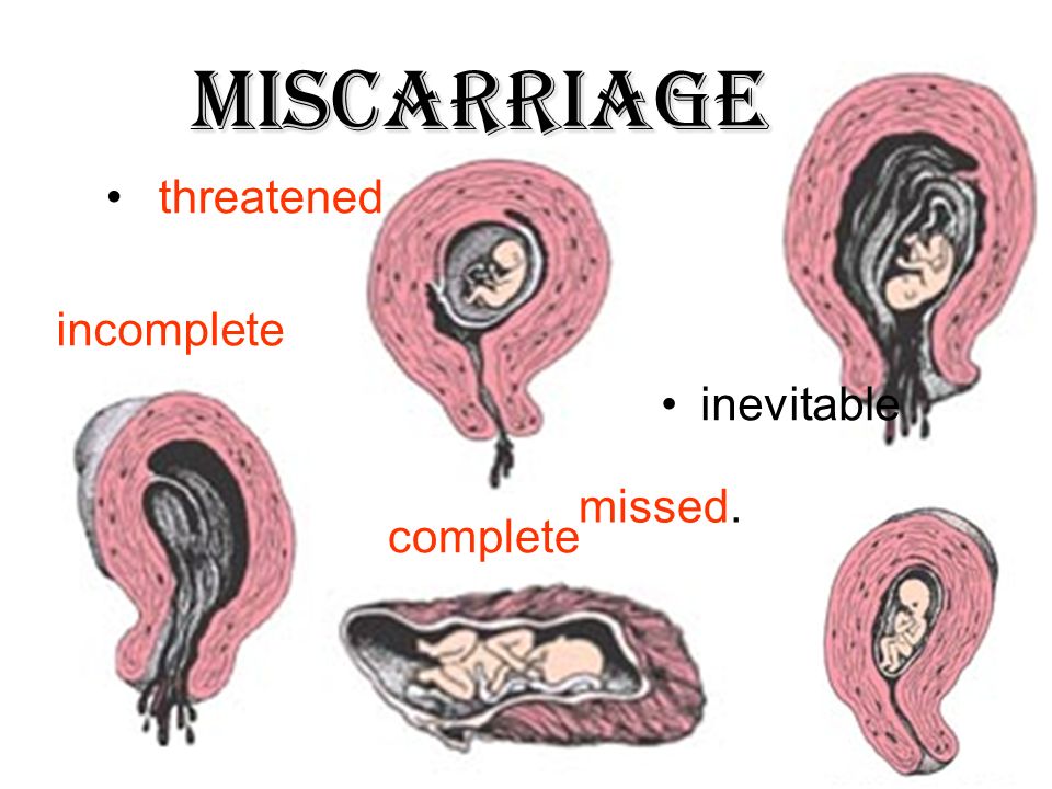 Masturbation linked to miscarriage