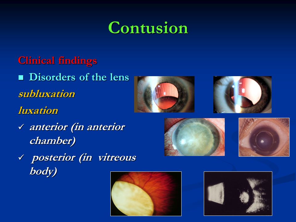Contusion Clinical findings Disorders of the lens subluxation luxation