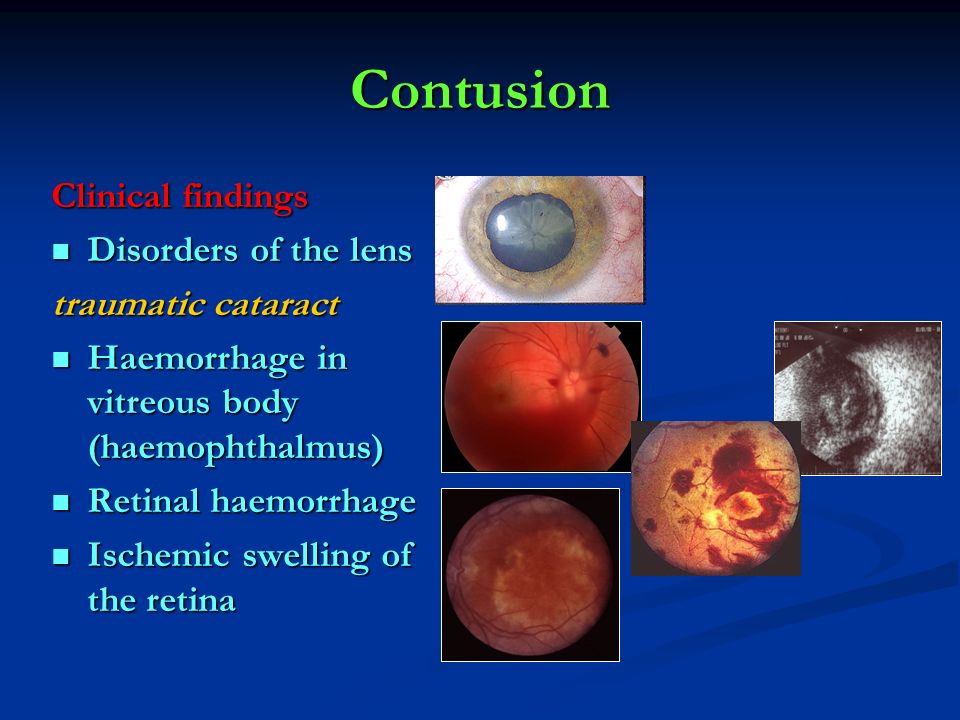 Contusion Clinical findings Disorders of the lens traumatic cataract