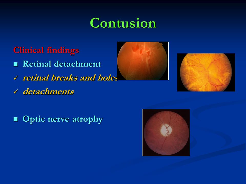 Contusion Clinical findings Retinal detachment