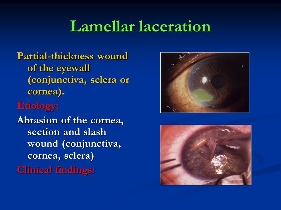 Lamellar laceration Partial-thickness wound of the eyewall (conjunctiva, sclera or cornea). Etiology: