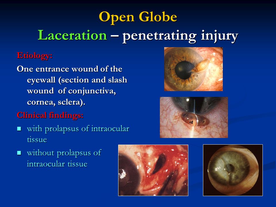 Open Globe Laceration – penetrating injury