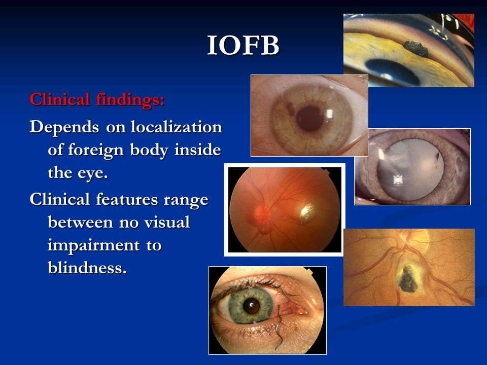IOFB Clinical findings: