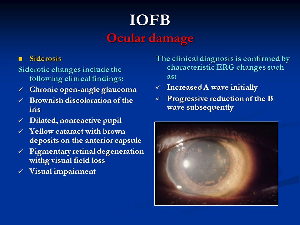 IOFB Ocular damage Siderosis