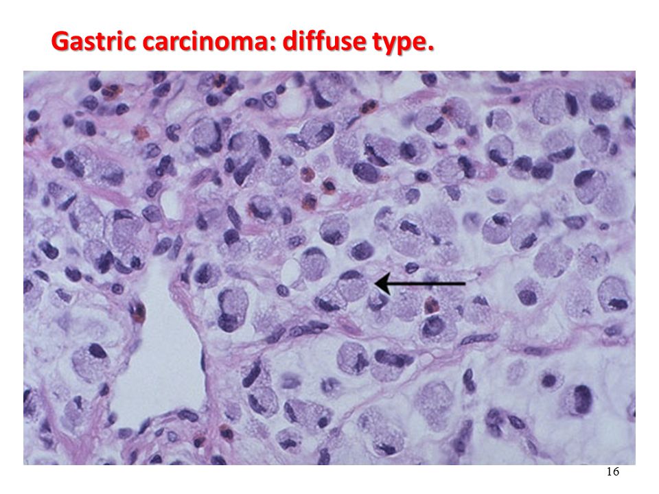 gastric carcinoma.