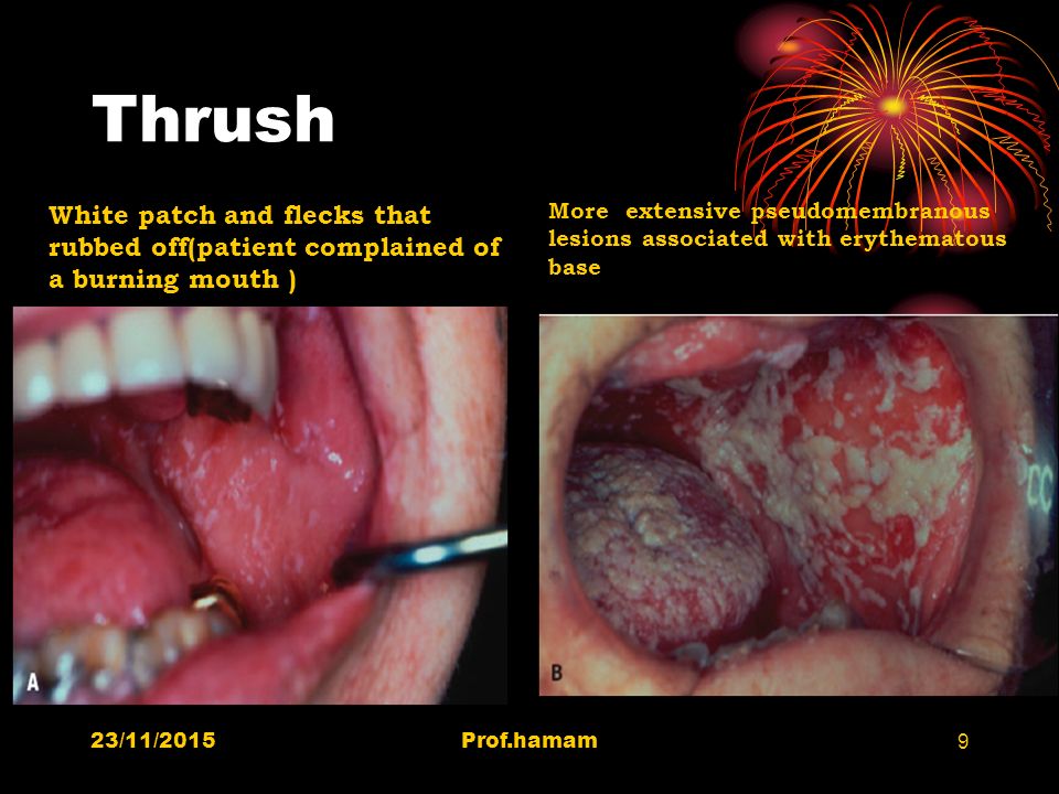 Thrush White patch and flecks that rubbed off(patient complained of a burning mouth )