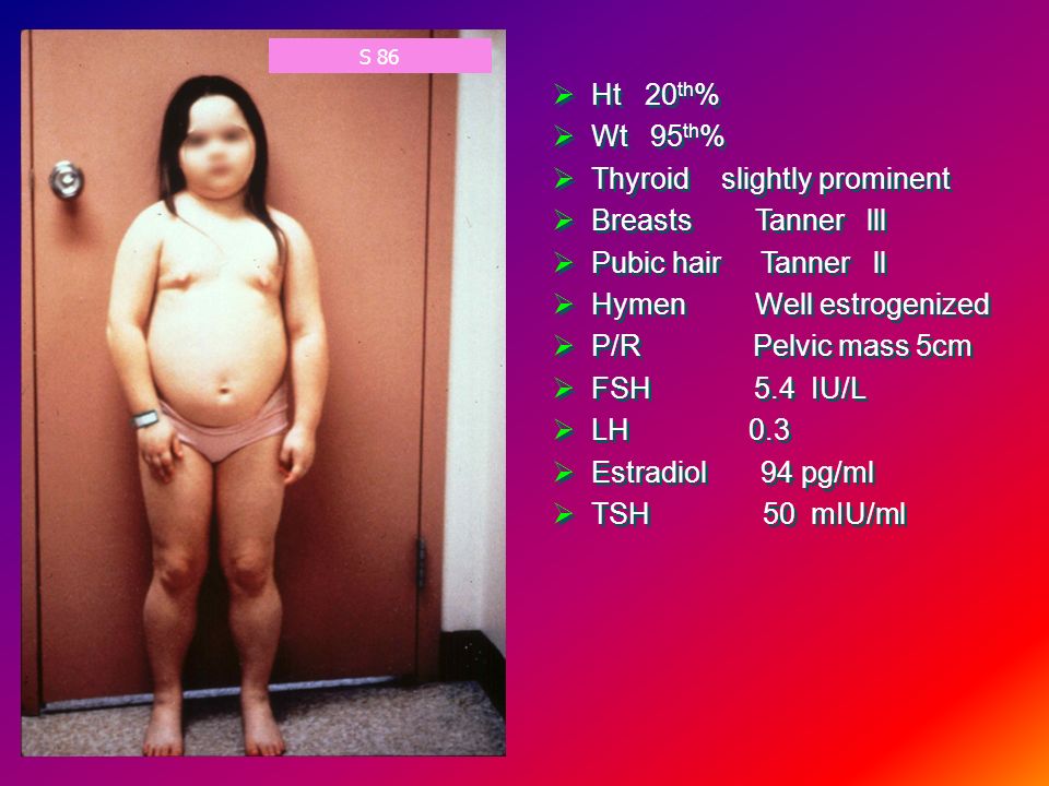 Precocious Puberty Dr Salwa Neyazi Precocious Puberty Ppt Daftsex Hd
