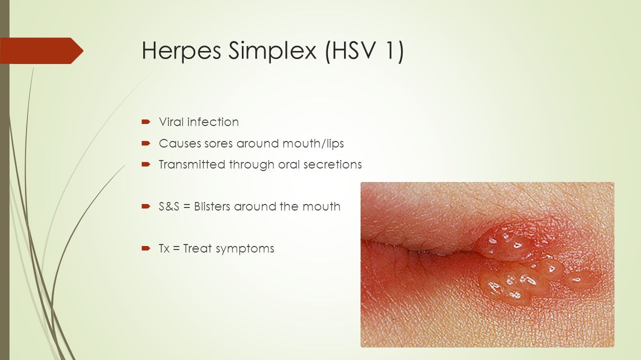 Herpes Simplex Virus Adalah Pdf Adventureneptun.