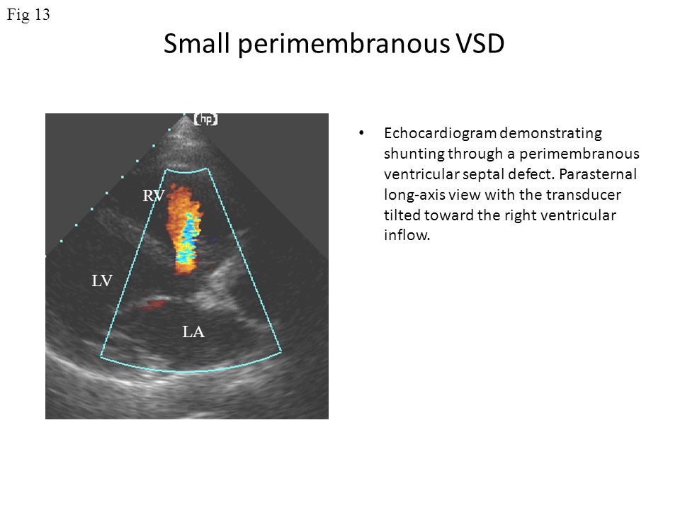 Small perimembranous VSD