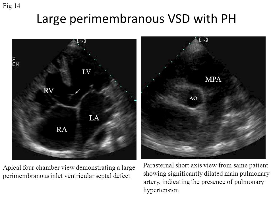 Large perimembranous VSD with PH