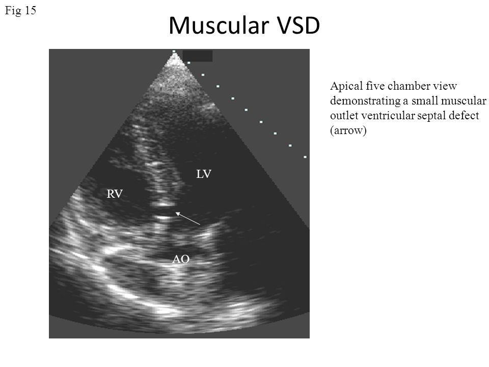 Muscular VSD Fig 15 Apical five chamber view
