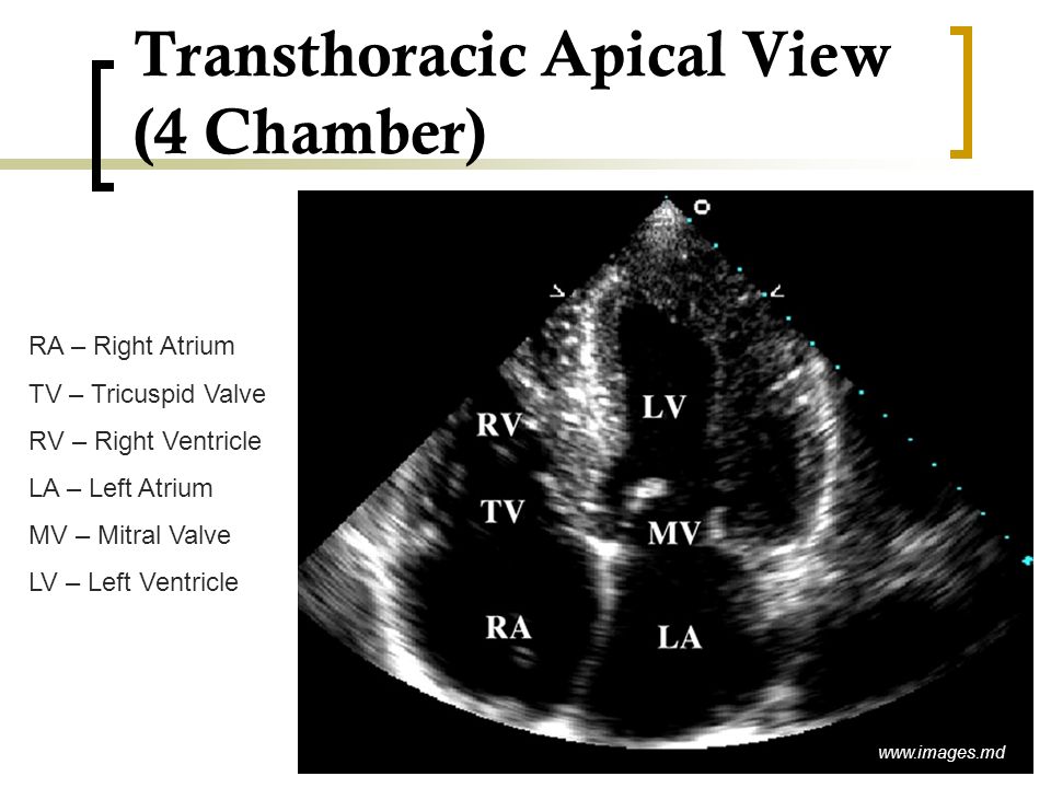 Transthoracic Apical View (4 Chamber)