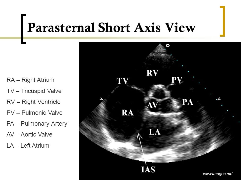 Parasternal Short Axis View