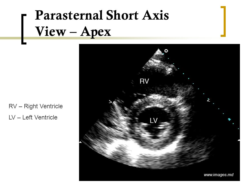 Parasternal Short Axis View – Apex