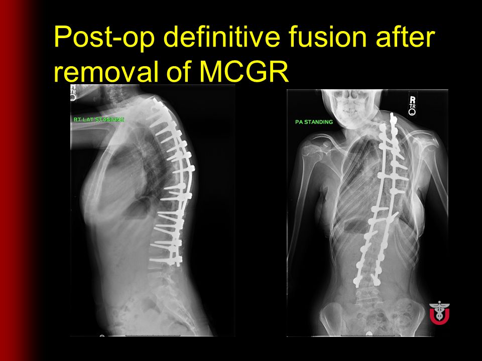 Post-op definitive fusion after removal of MCGR