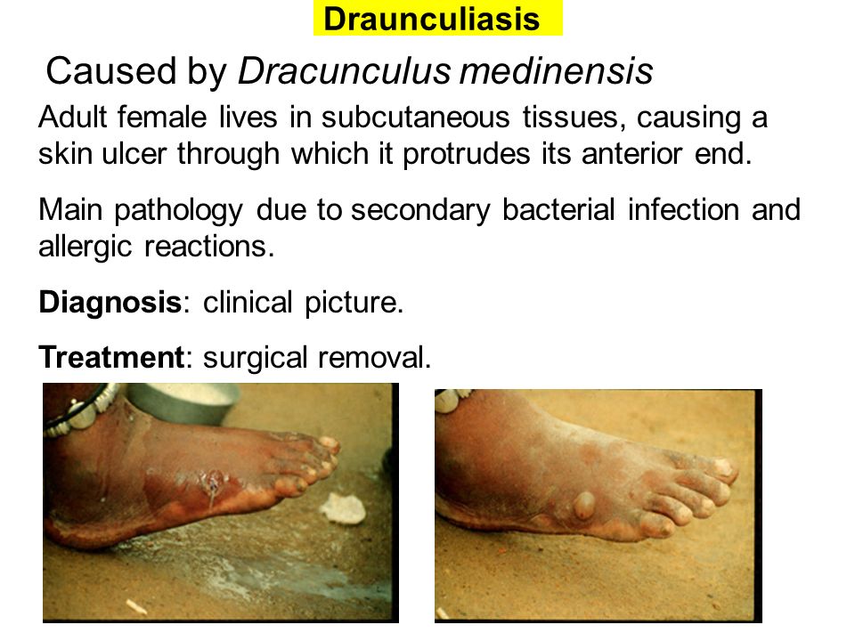 Caused by Dracunculus medinensis