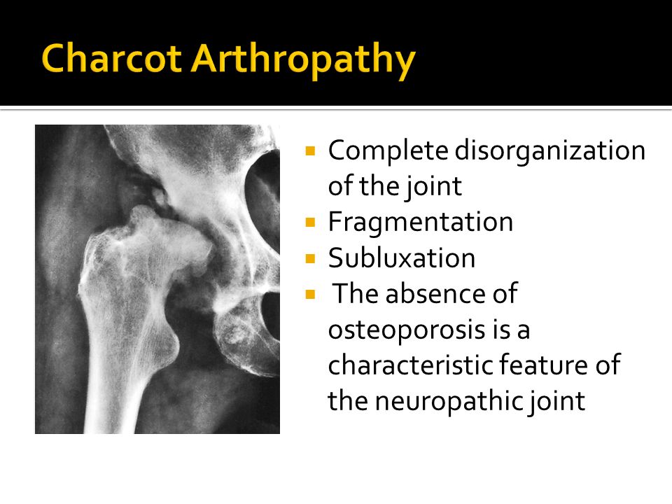 Charcot Arthropathy Complete disorganization of the joint