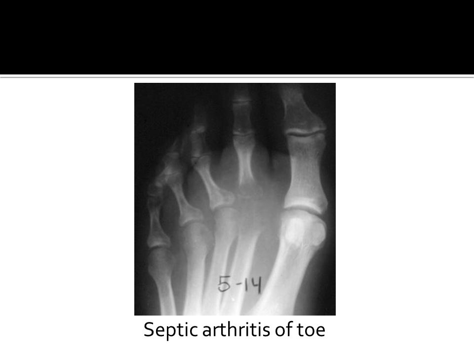 Septic arthritis of toe