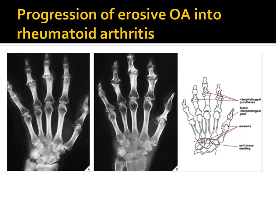 Progression of erosive OA into rheumatoid arthritis