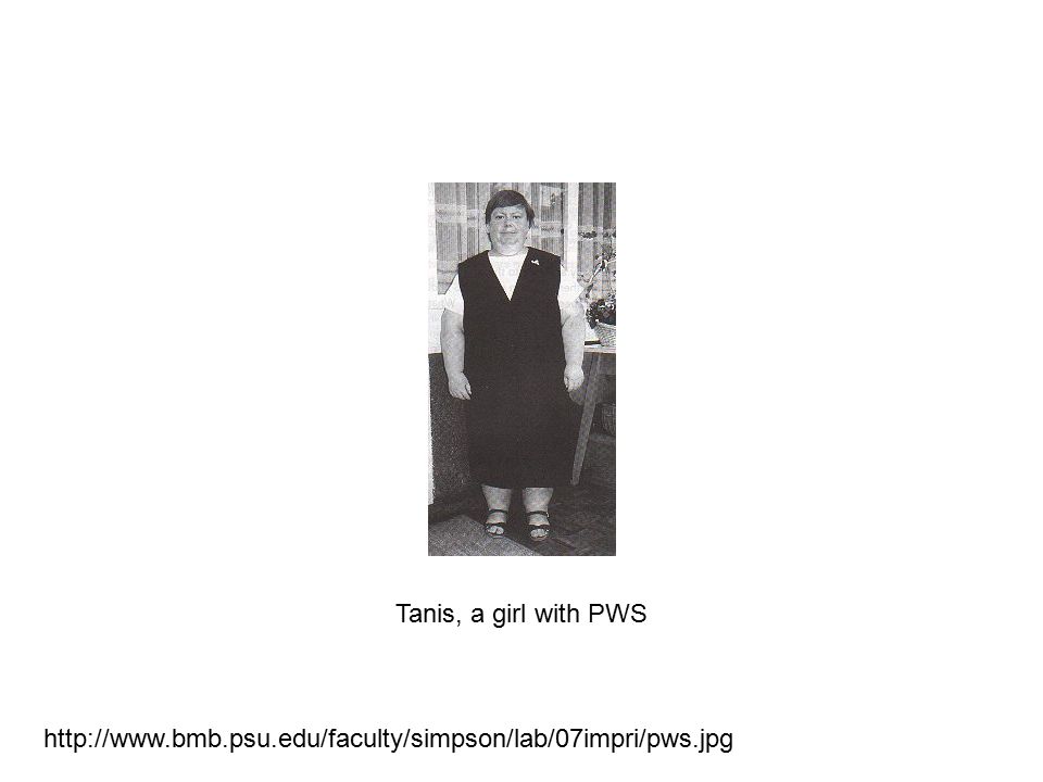 Tanis, a girl with PWS