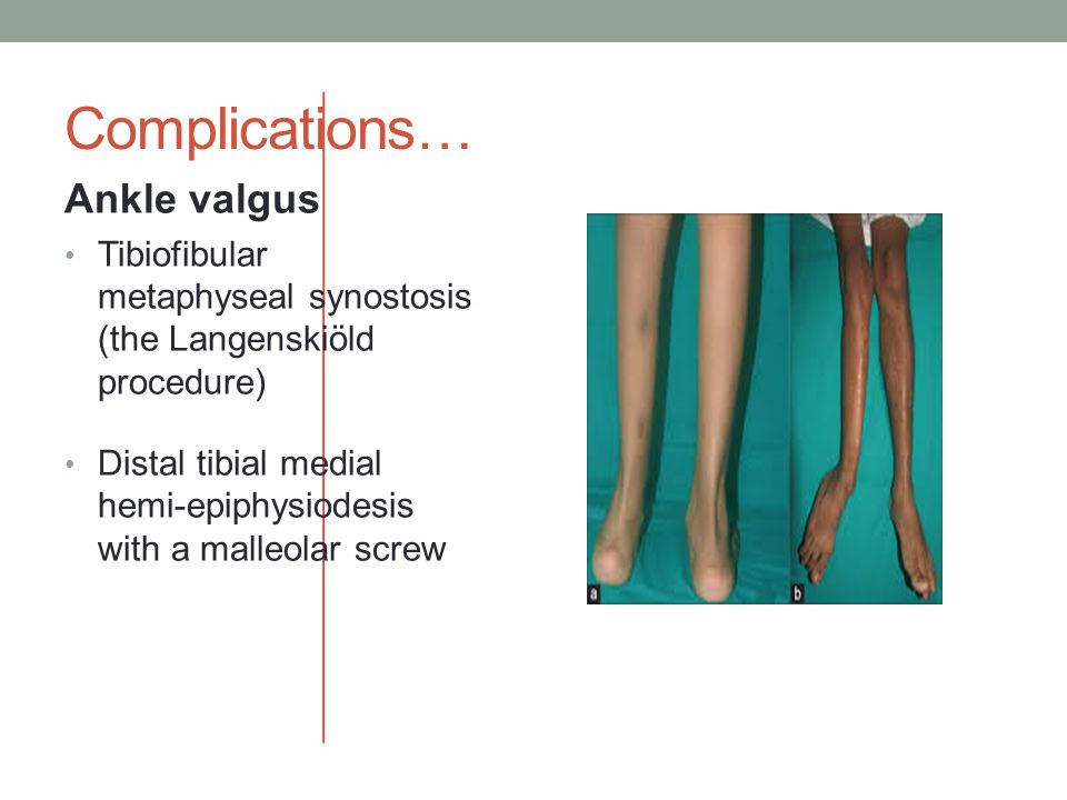 Complications… Ankle valgus