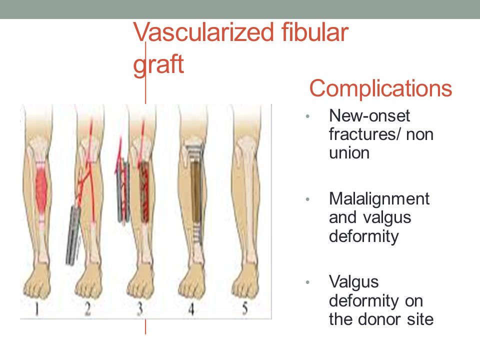 Vascularized fibular graft