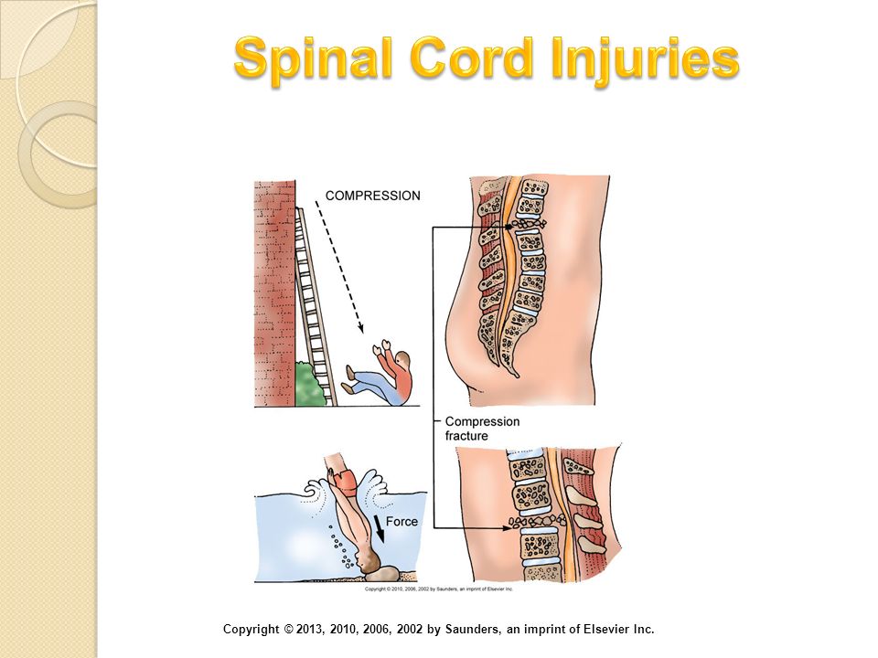 Spinal Cord Injuries Axial loading (vertical compression) injury of the cervical spine and the lumbar spine.