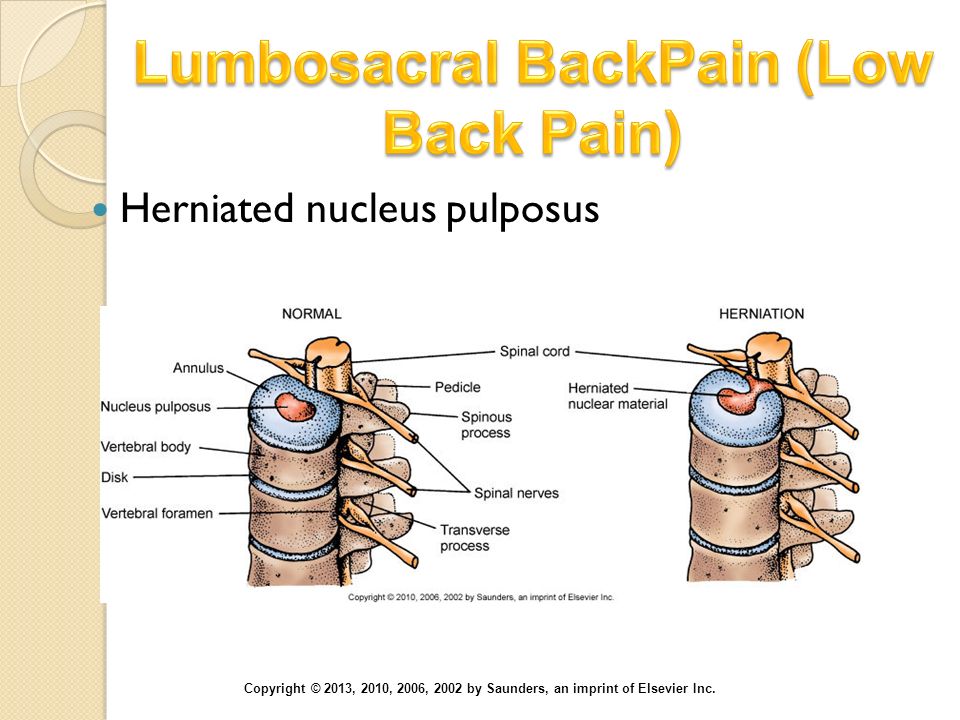 Lumbosacral BackPain (Low Back Pain)