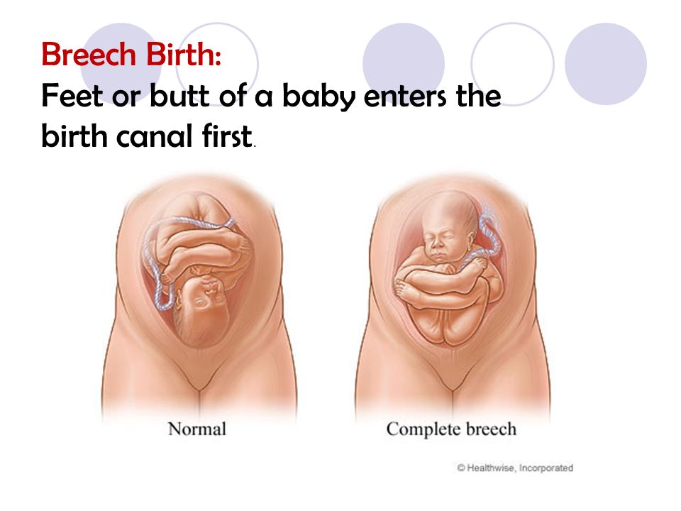 Vaginal birth breech position