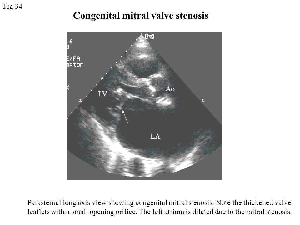 Congenital mitral valve stenosis