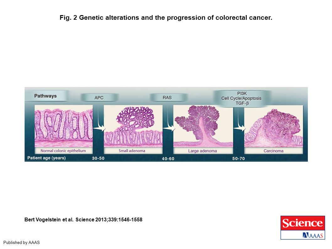 Fig. 2 Genetic alterations and the progression of colorectal cancer.