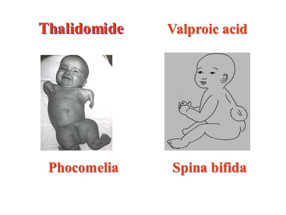 Thalidomide Valproic acid Phocomelia Spina bifida