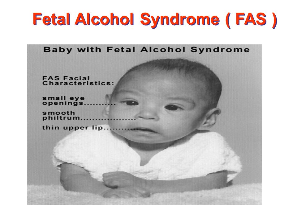 Fetal Alcohol Syndrome ( FAS )
