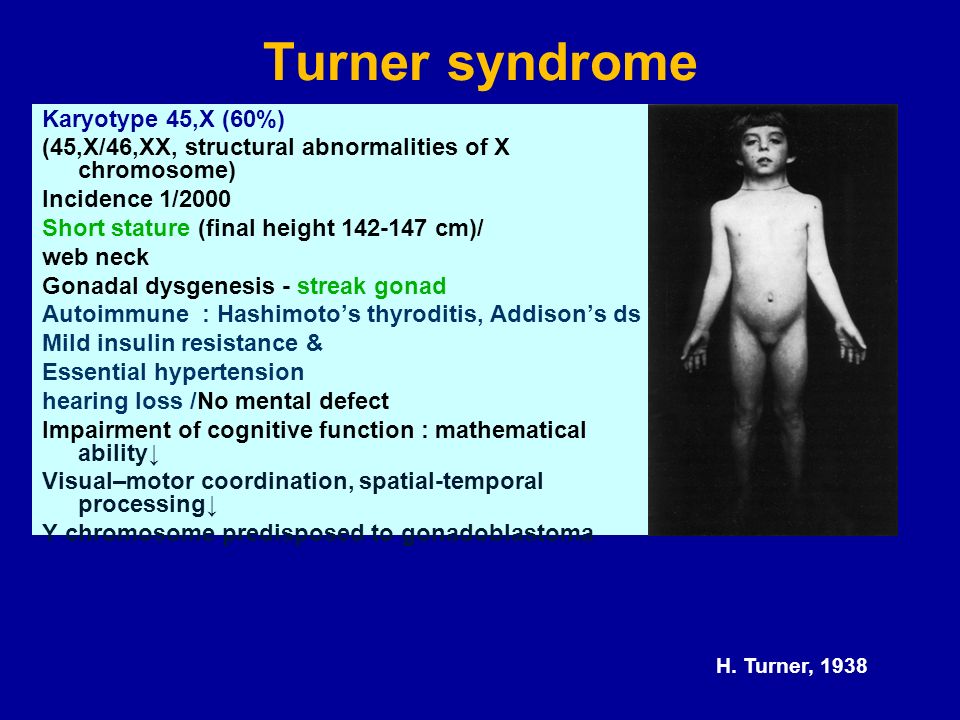 Turner syndrome Karyotype 45,X (60%)