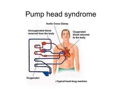 Pump head syndrome On May 6, 1953, the heart-lung machine was first used successfully on 18 year old Cecelia Bavolek. In the six months before surgery,