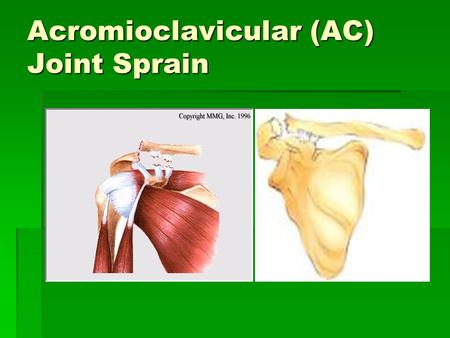 Acromioclavicular (AC) Joint Sprain. What is the AC joint? Its a joint in the shoulder that consists of the lateral end of the clavicle and the acromion.
