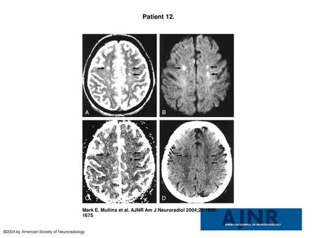 Patient 12. Patient 12. A 43-year-old woman with headache, blurred vision, and mental status change.A, T2-weighted axial MR image shows bilateral centrum.