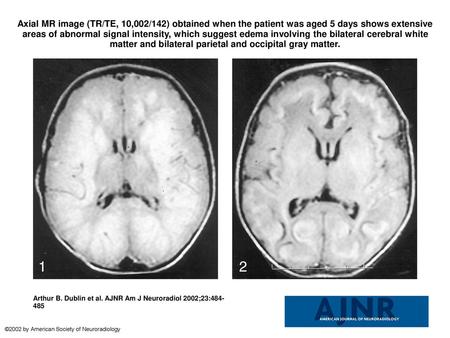 Axial MR image (TR/TE, 10,002/142) obtained when the patient was aged 5 days shows extensive areas of abnormal signal intensity, which suggest edema involving.