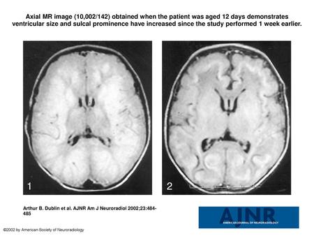 Axial MR image (10,002/142) obtained when the patient was aged 12 days demonstrates ventricular size and sulcal prominence have increased since the study.