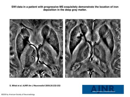 SWI data in a patient with progressive MS exquisitely demonstrate the location of iron deposition in the deep gray matter. SWI data in a patient with progressive.